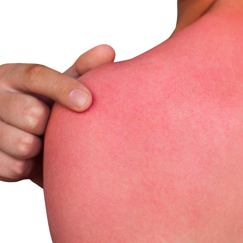 Ways to treat sunburn